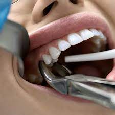 Tooth Extraction