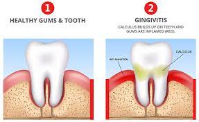 Gingivitis