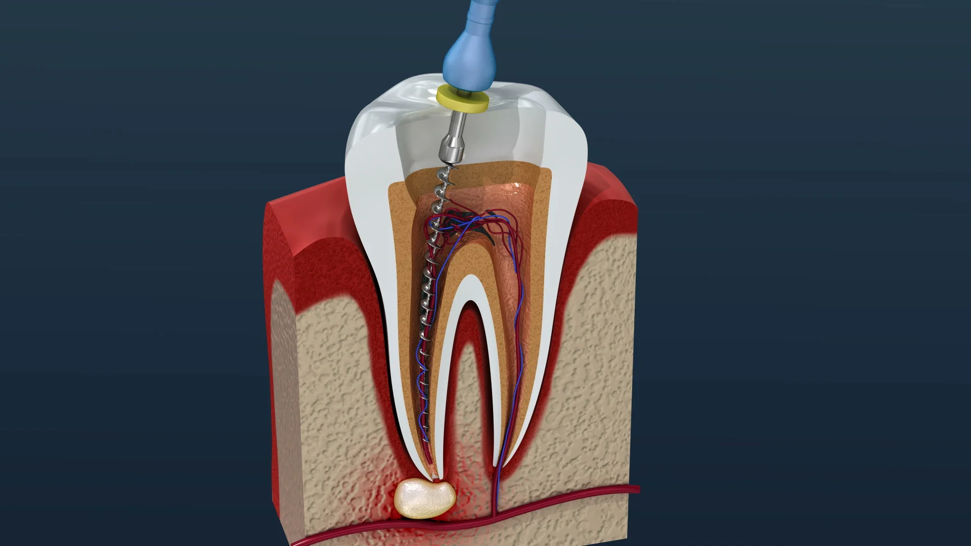 RootCanal Treatment